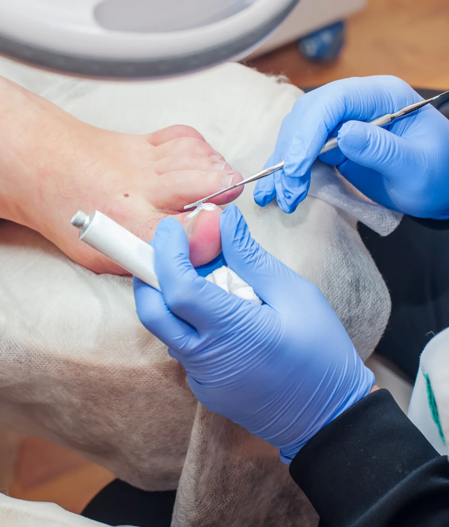 Thickened, discoloured toenails affected by a fungal infection