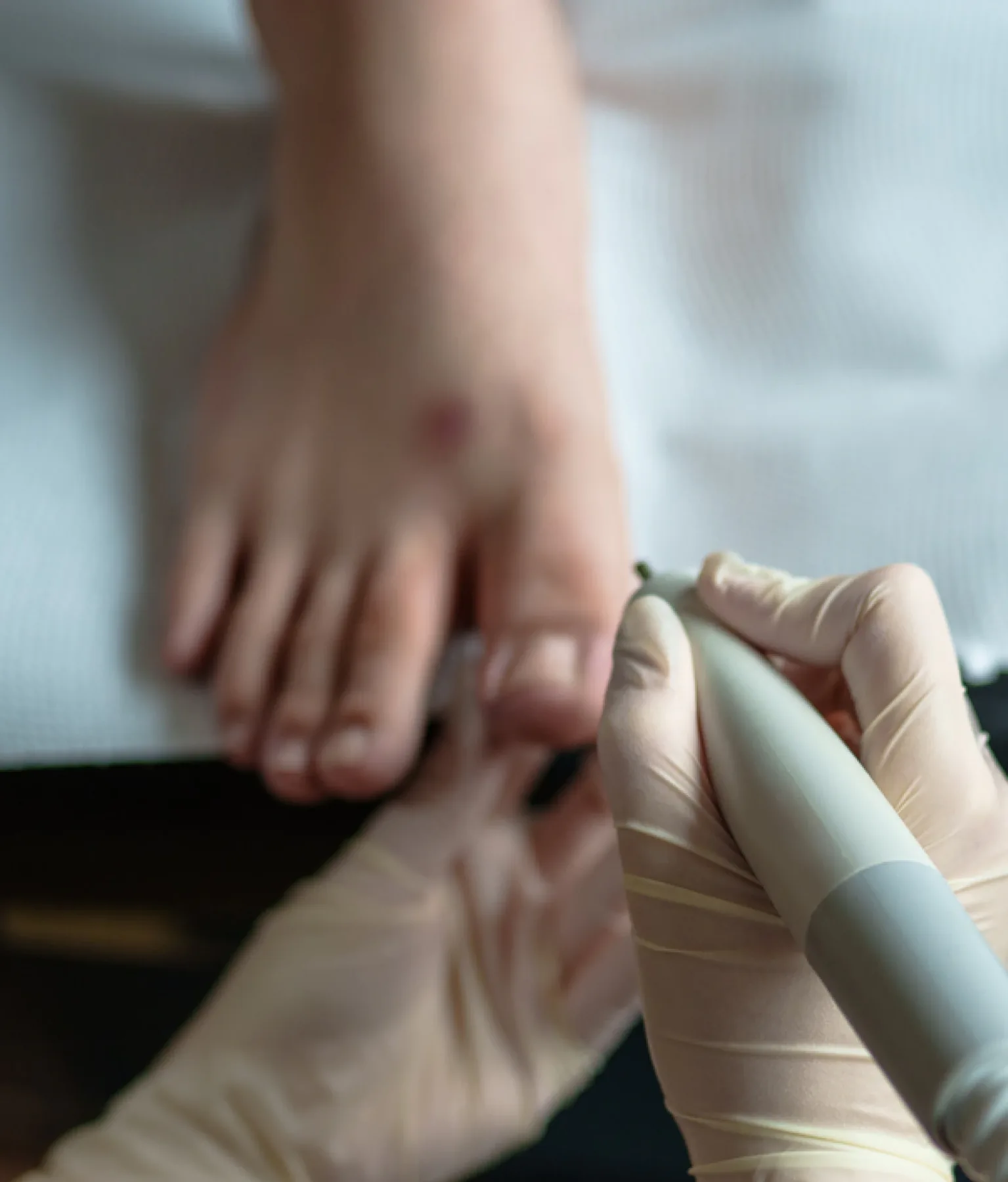 The edge of a big toenail growing into the surrounding skin